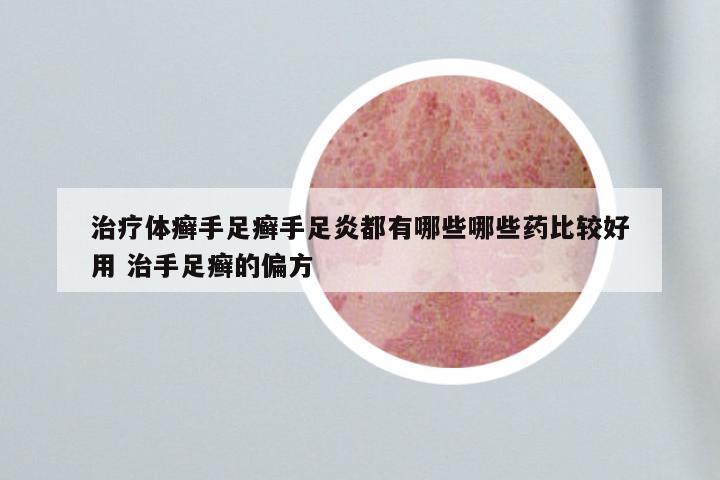 治疗体癣手足癣手足炎都有哪些哪些药比较好用 治手足癣的偏方