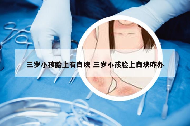 三岁小孩脸上有白块 三岁小孩脸上白块咋办