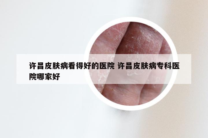 许昌皮肤病看得好的医院 许昌皮肤病专科医院哪家好