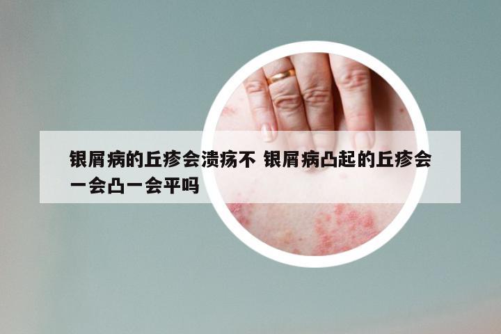 银屑病的丘疹会溃疡不 银屑病凸起的丘疹会一会凸一会平吗