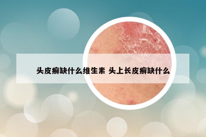 头皮癣缺什么维生素 头上长皮癣缺什么