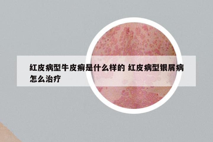 红皮病型牛皮癣是什么样的 红皮病型银屑病怎么治疗
