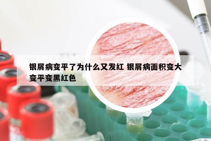 银屑病变平了为什么又发红 银屑病面积变大变平变黑红色