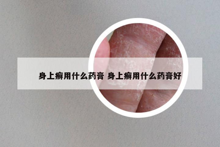 身上癣用什么药膏 身上癣用什么药膏好