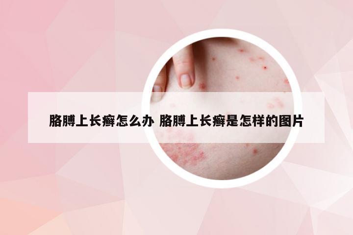 胳膊上长癣怎么办 胳膊上长癣是怎样的图片
