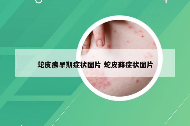 蛇皮癣早期症状图片 蛇皮藓症状图片