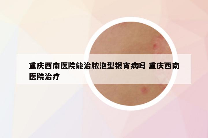 重庆西南医院能治脓泡型银宵病吗 重庆西南医院治疗