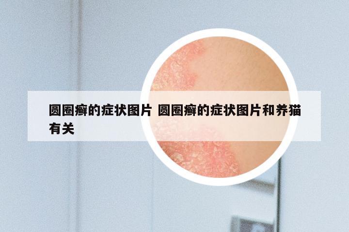 圆圈癣的症状图片 圆圈癣的症状图片和养猫有关