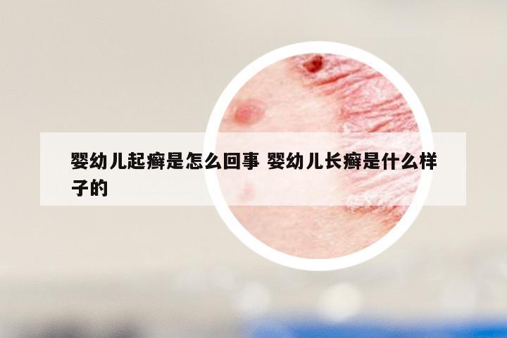 婴幼儿起癣是怎么回事 婴幼儿长癣是什么样子的