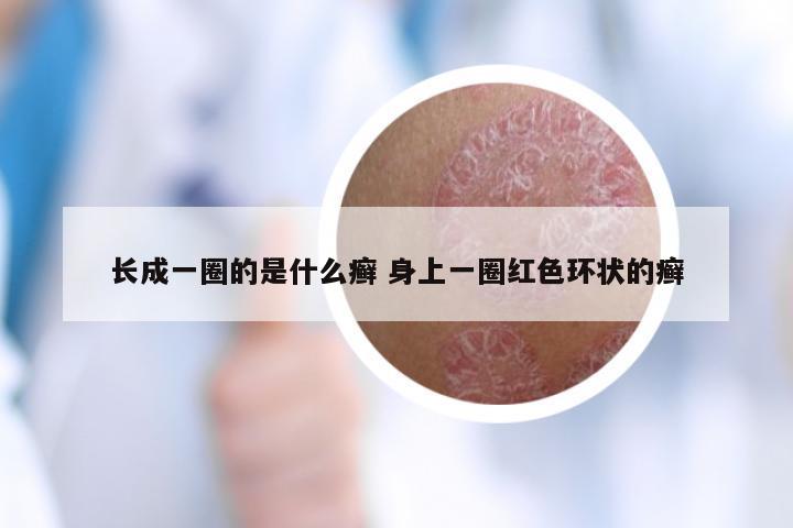 长成一圈的是什么癣 身上一圈红色环状的癣