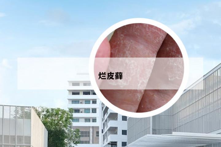 烂皮藓