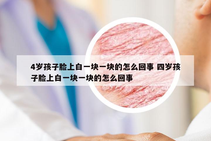 4岁孩子脸上白一块一块的怎么回事 四岁孩子脸上白一块一块的怎么回事