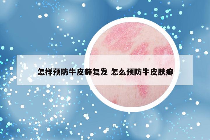 怎样预防牛皮藓复发 怎么预防牛皮肤癣