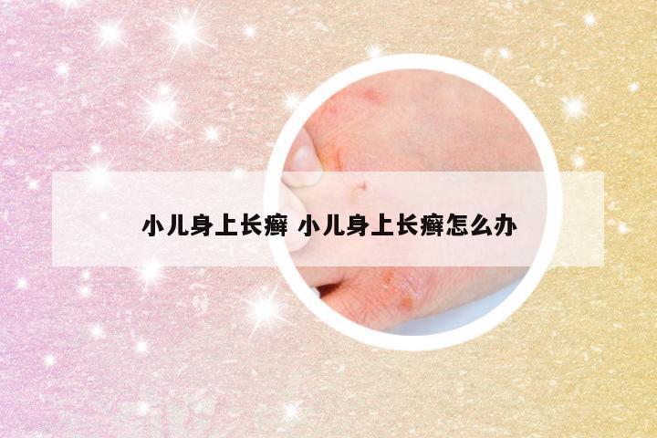 小儿身上长癣 小儿身上长癣怎么办