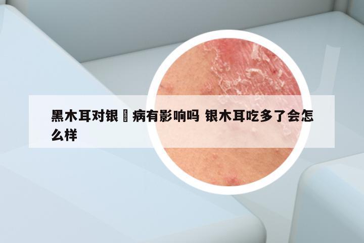 黑木耳对银痟病有影响吗 银木耳吃多了会怎么样
