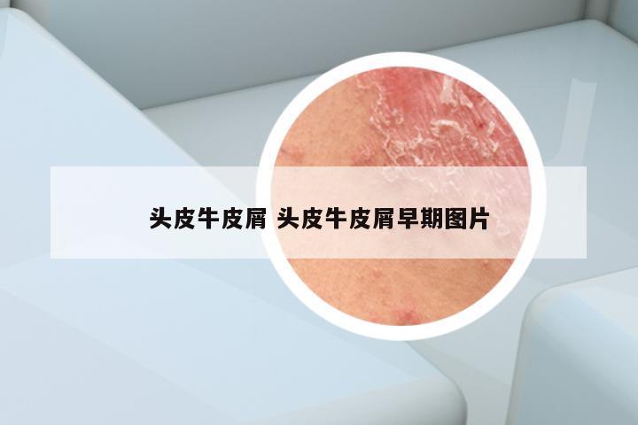 头皮牛皮屑 头皮牛皮屑早期图片