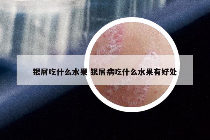 银屑吃什么水果 银屑病吃什么水果有好处