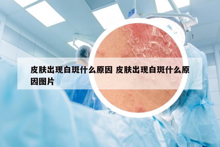 皮肤出现白斑什么原因 皮肤出现白斑什么原因图片