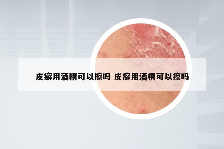 皮癣用酒精可以擦吗 皮癣用酒精可以擦吗