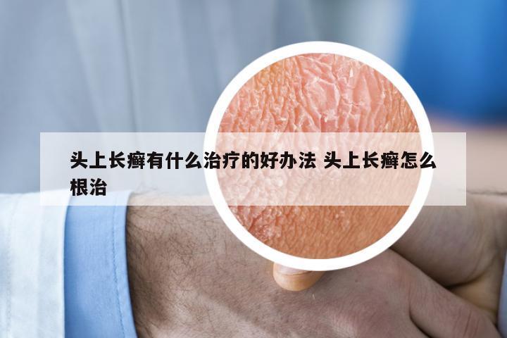 头上长癣有什么治疗的好办法 头上长癣怎么根治