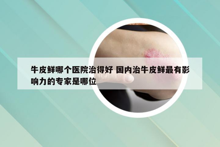 牛皮鲜哪个医院治得好 国内治牛皮鲜最有影响力的专家是哪位