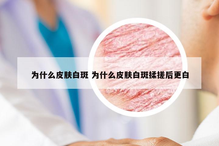为什么皮肤白斑 为什么皮肤白斑揉搓后更白