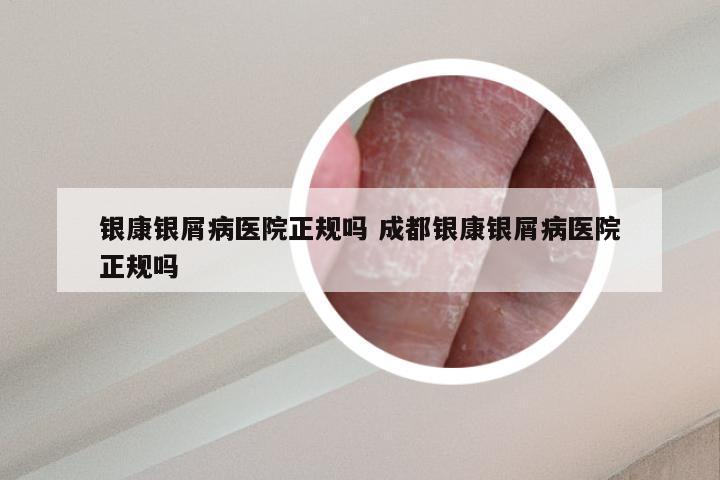 银康银屑病医院正规吗 成都银康银屑病医院正规吗