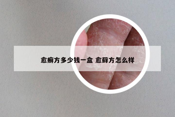 愈癣方多少钱一盒 愈藓方怎么样