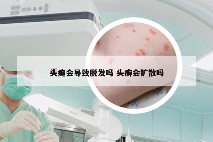 头癣会导致脱发吗 头癣会扩散吗