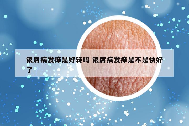 银屑病发痒是好转吗 银屑病发痒是不是快好了