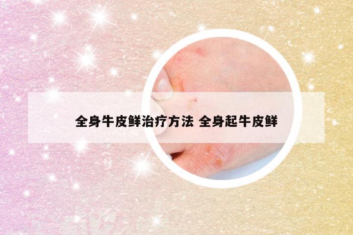 全身牛皮鲜治疗方法 全身起牛皮鲜