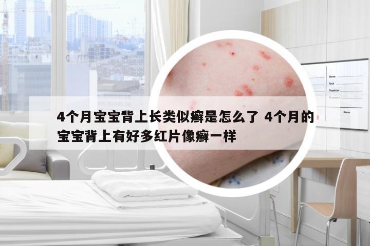4个月宝宝背上长类似癣是怎么了 4个月的宝宝背上有好多红片像癣一样