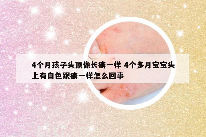 4个月孩子头顶像长癣一样 4个多月宝宝头上有白色跟癣一样怎么回事