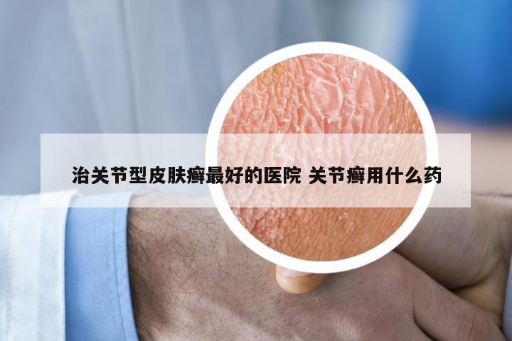 治关节型皮肤癣最好的医院 关节癣用什么药
