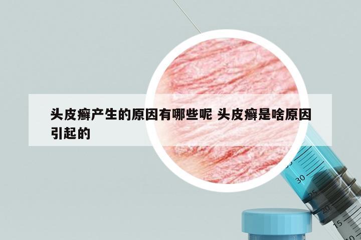 头皮癣产生的原因有哪些呢 头皮癣是啥原因引起的