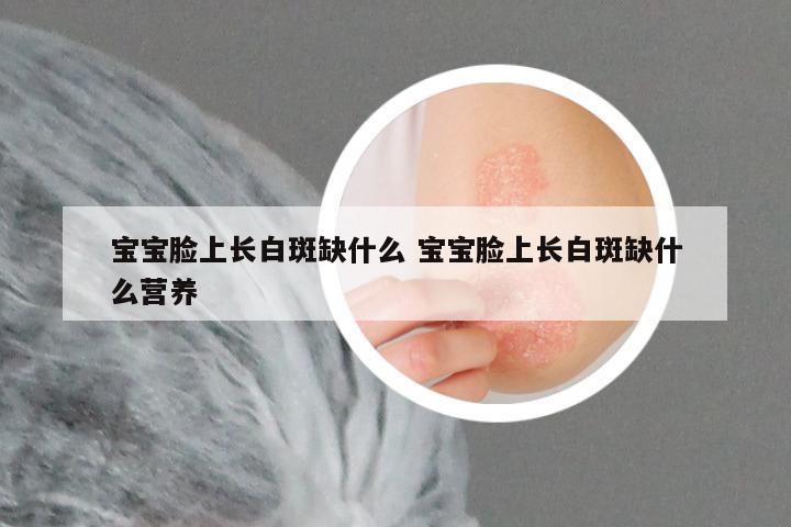 宝宝脸上长白斑缺什么 宝宝脸上长白斑缺什么营养