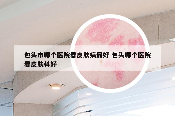 包头市哪个医院看皮肤病最好 包头哪个医院看皮肤科好