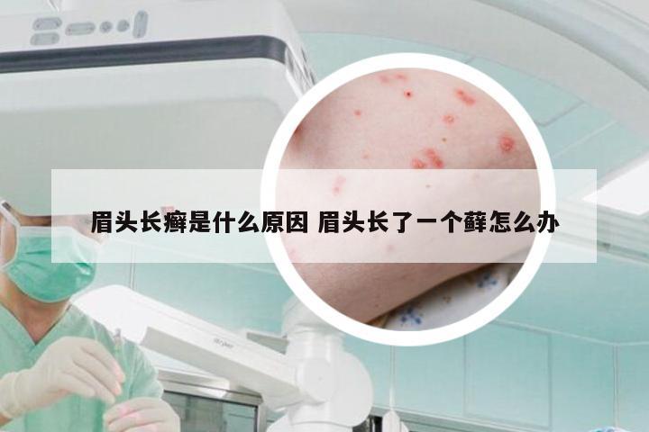 眉头长癣是什么原因 眉头长了一个藓怎么办