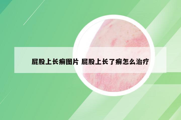 屁股上长癣图片 屁股上长了癣怎么治疗