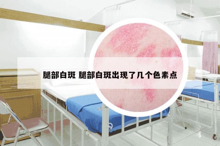 腿部白斑 腿部白斑出现了几个色素点