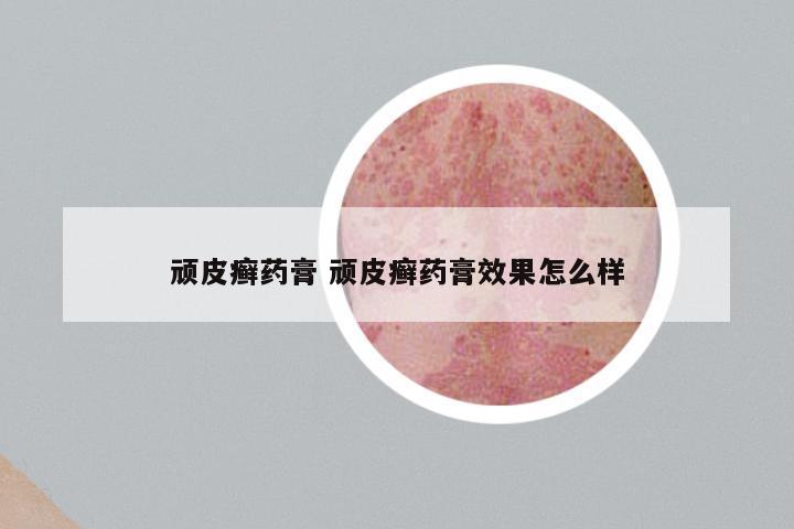 顽皮癣药膏 顽皮癣药膏效果怎么样