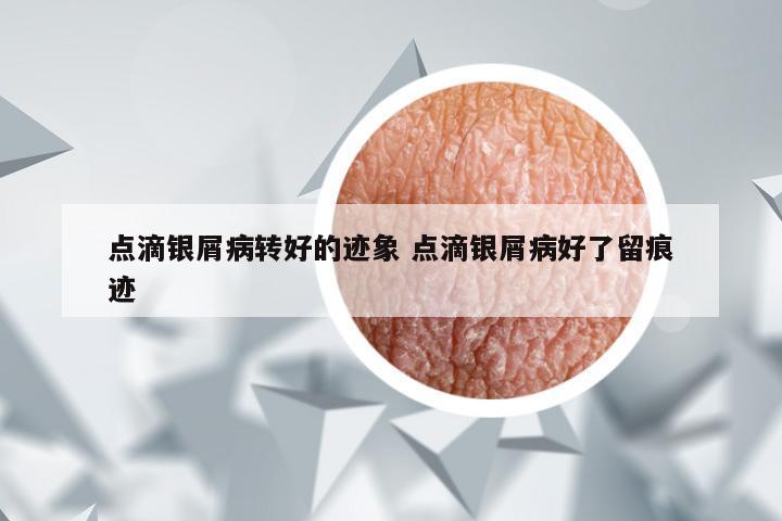 点滴银屑病转好的迹象 点滴银屑病好了留痕迹
