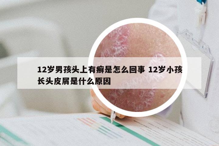 12岁男孩头上有癣是怎么回事 12岁小孩长头皮屑是什么原因