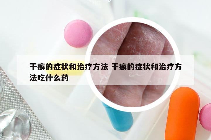 干癣的症状和治疗方法 干癣的症状和治疗方法吃什么药