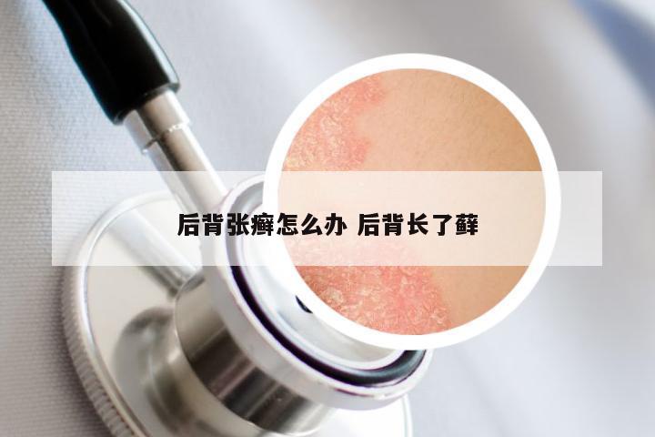 后背张癣怎么办 后背长了藓