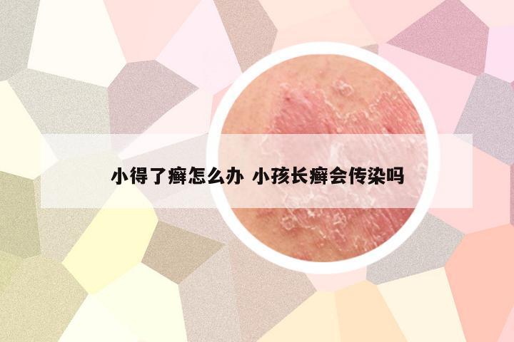 小得了癣怎么办 小孩长癣会传染吗
