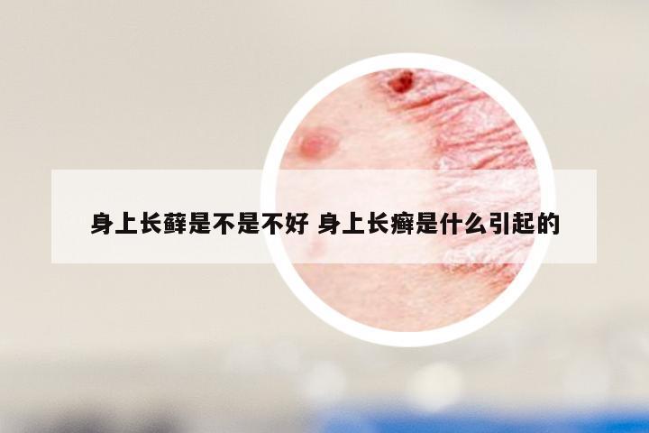 身上长藓是不是不好 身上长癣是什么引起的