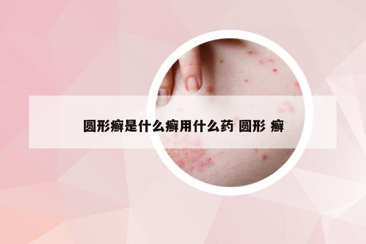 圆形癣是什么癣用什么药 圆形 癣
