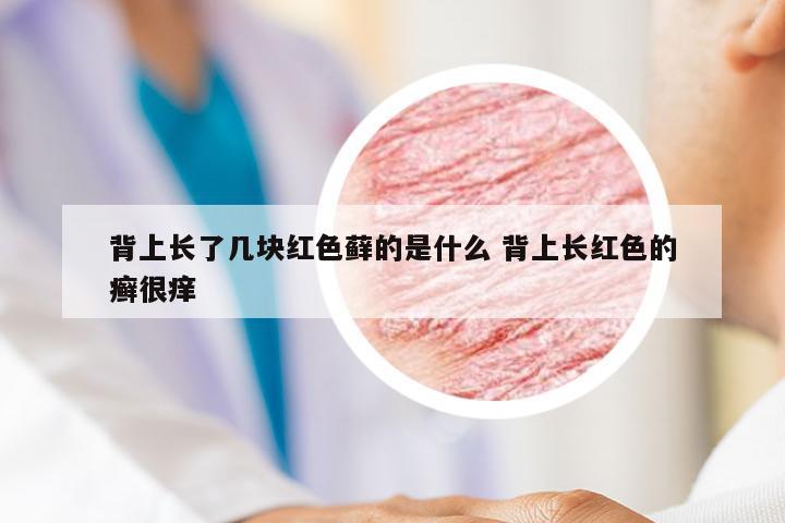 背上长了几块红色藓的是什么 背上长红色的癣很痒