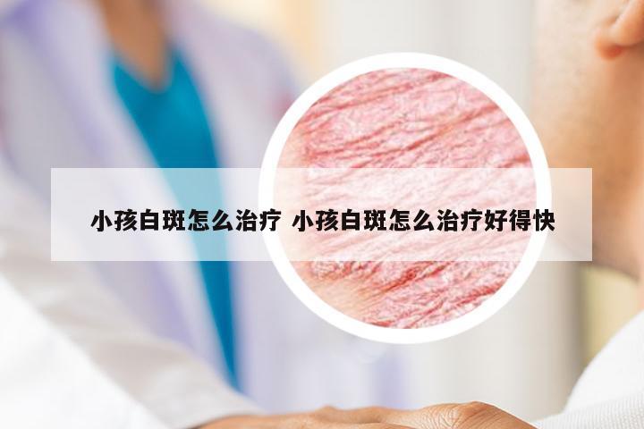 小孩白斑怎么治疗 小孩白斑怎么治疗好得快